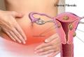 Malattia della fibromatosi uterina: che cos'è Cos'è il fibroma uterino